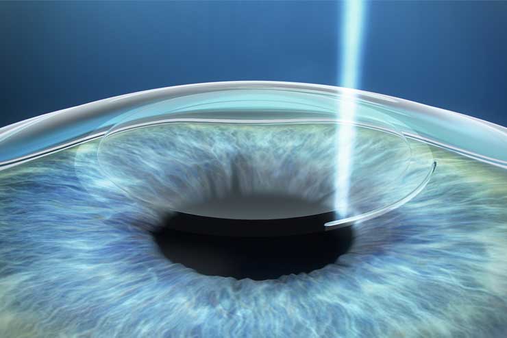 Laser-Vision-Consultation